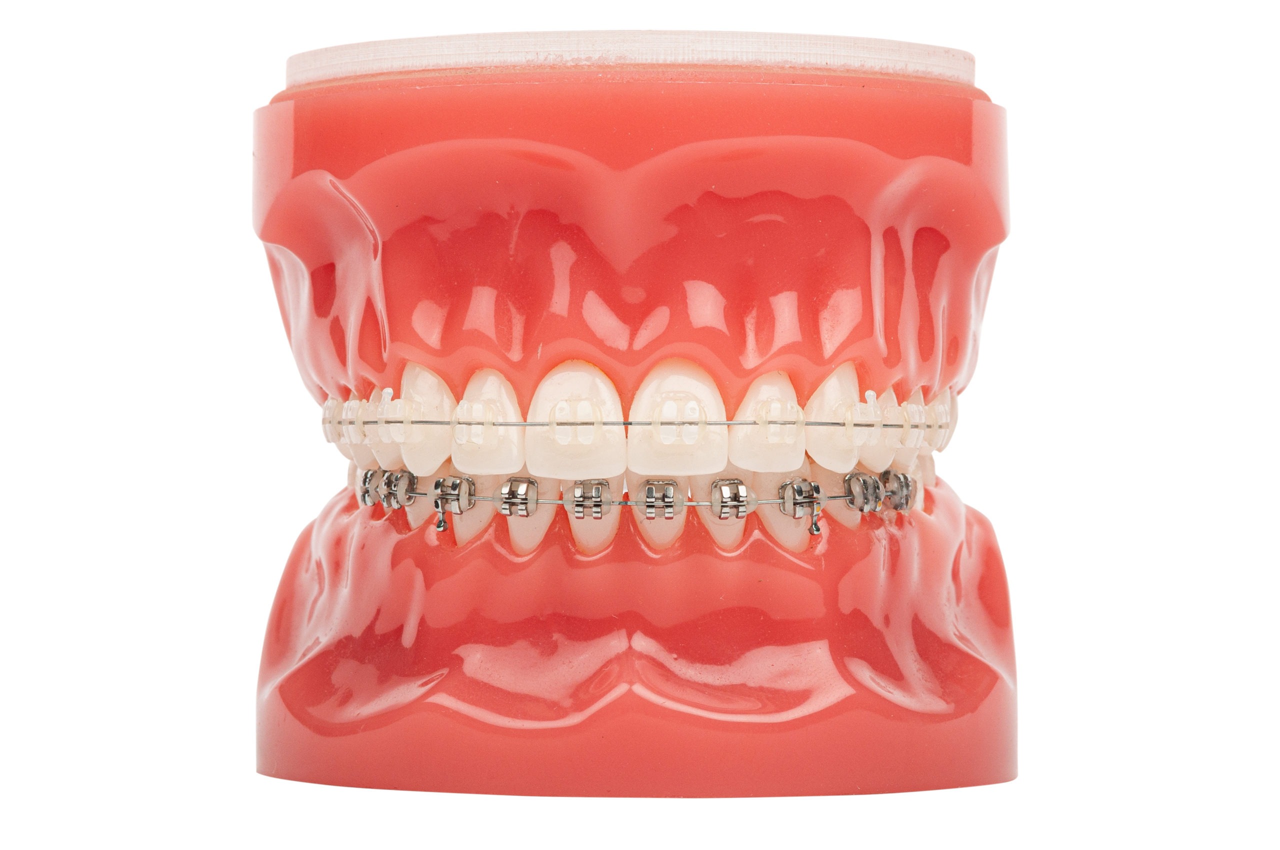 Orthodontic model demonstration teeth model of orthodontic brack