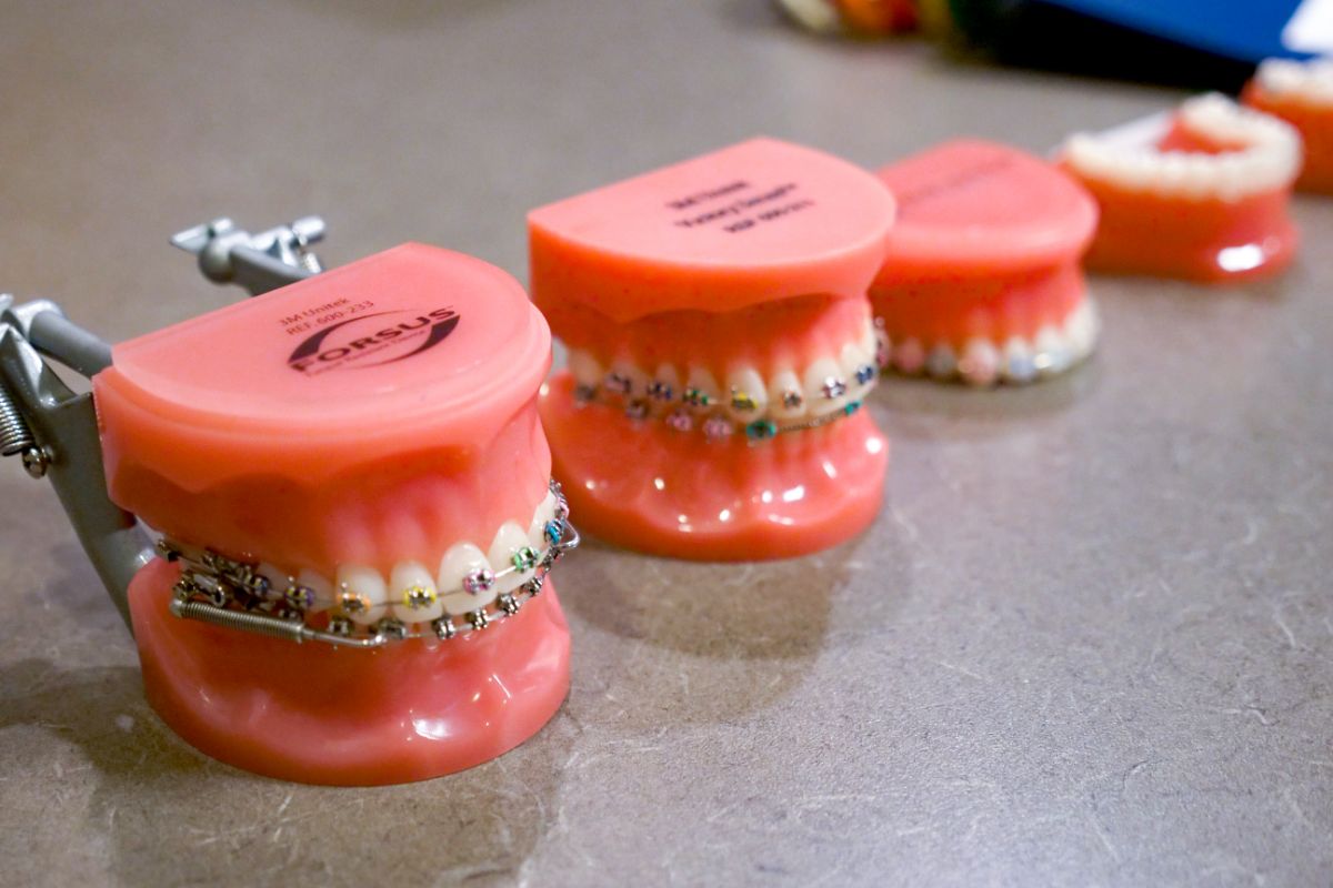 Dental models with braces displayed on a table, showcasing orthodontic treatment options. Brightly colored, they illustrate different stages of dental alignment.