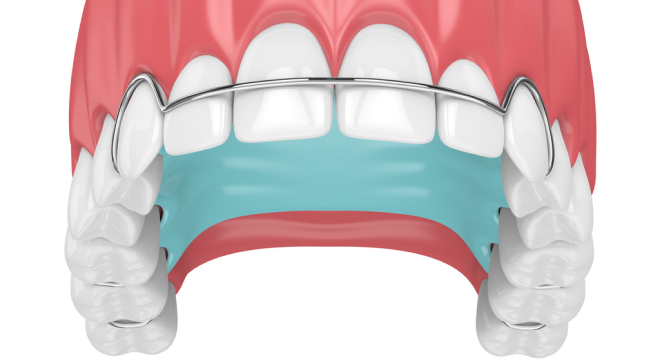 Hawley style retainer