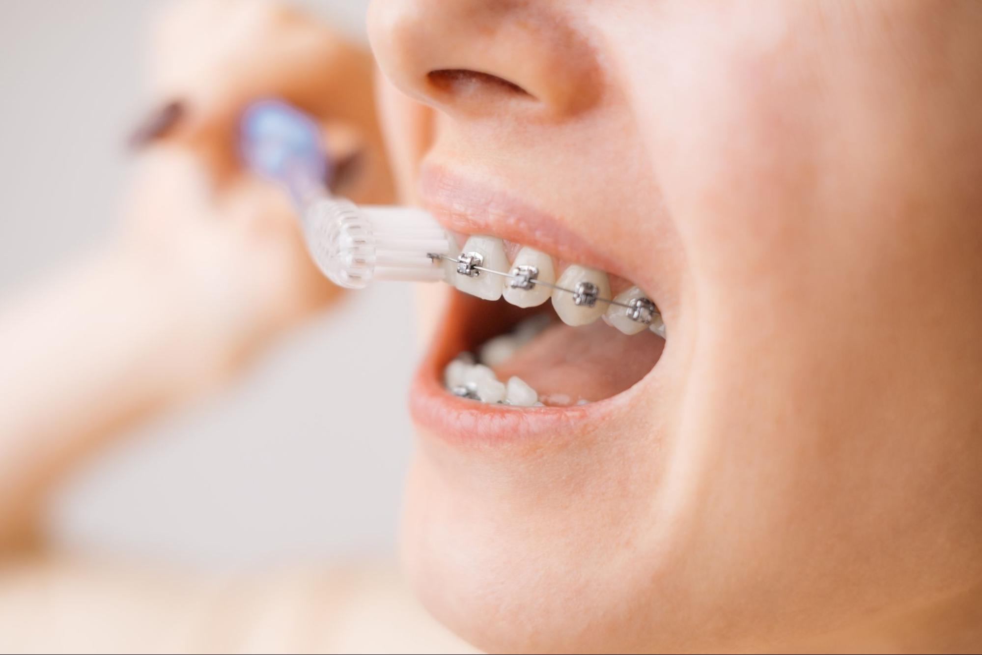 A person is brushing teeth with orthodontic braces, using a toothbrush for cleaning. The focus is on dental hygiene and oral care.