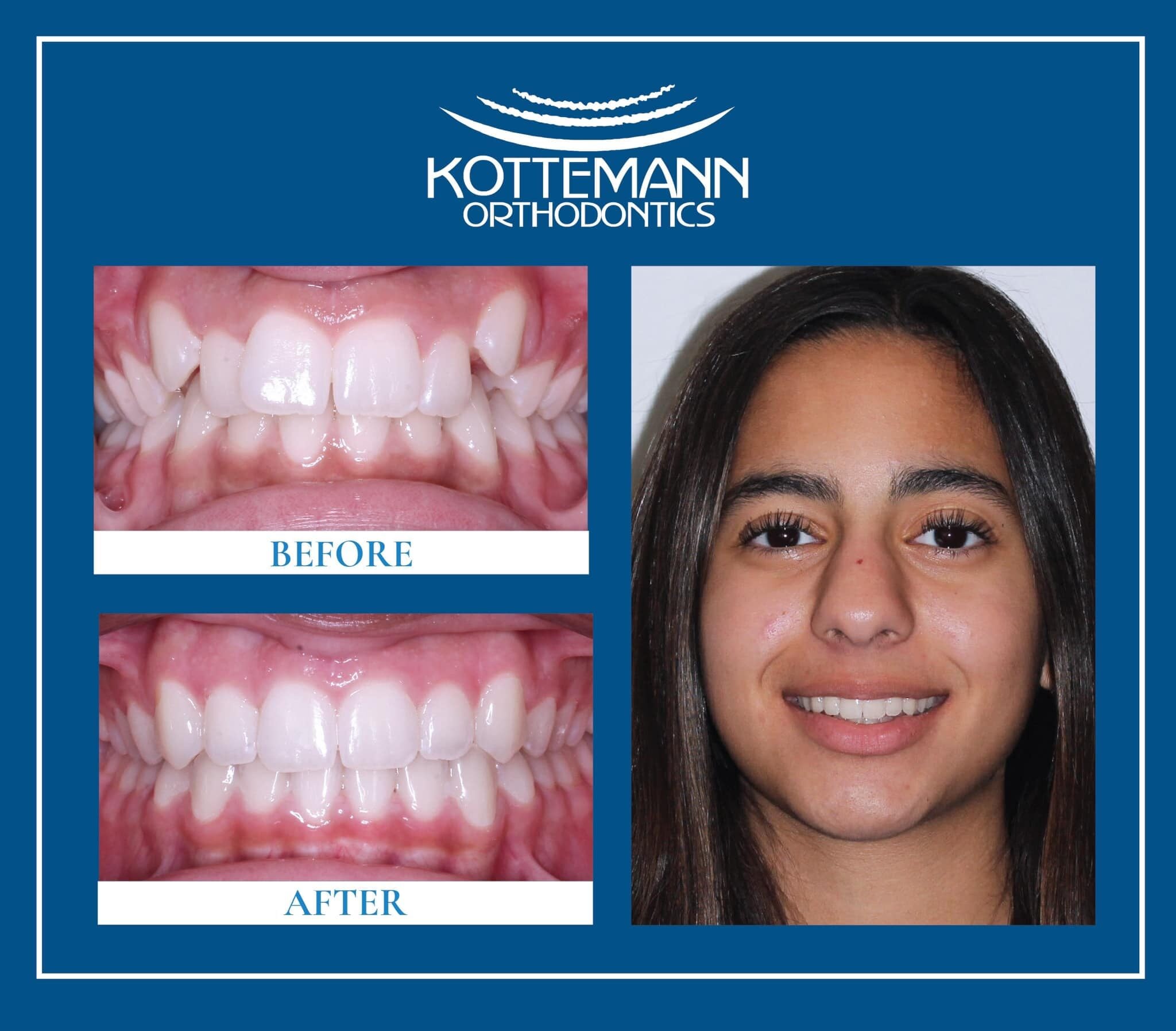 Smiling person showcasing orthodontic transformation, with before and after dental images. The logo reads "Kottmann Orthodontics" and emphasizes "Smile Transformations."