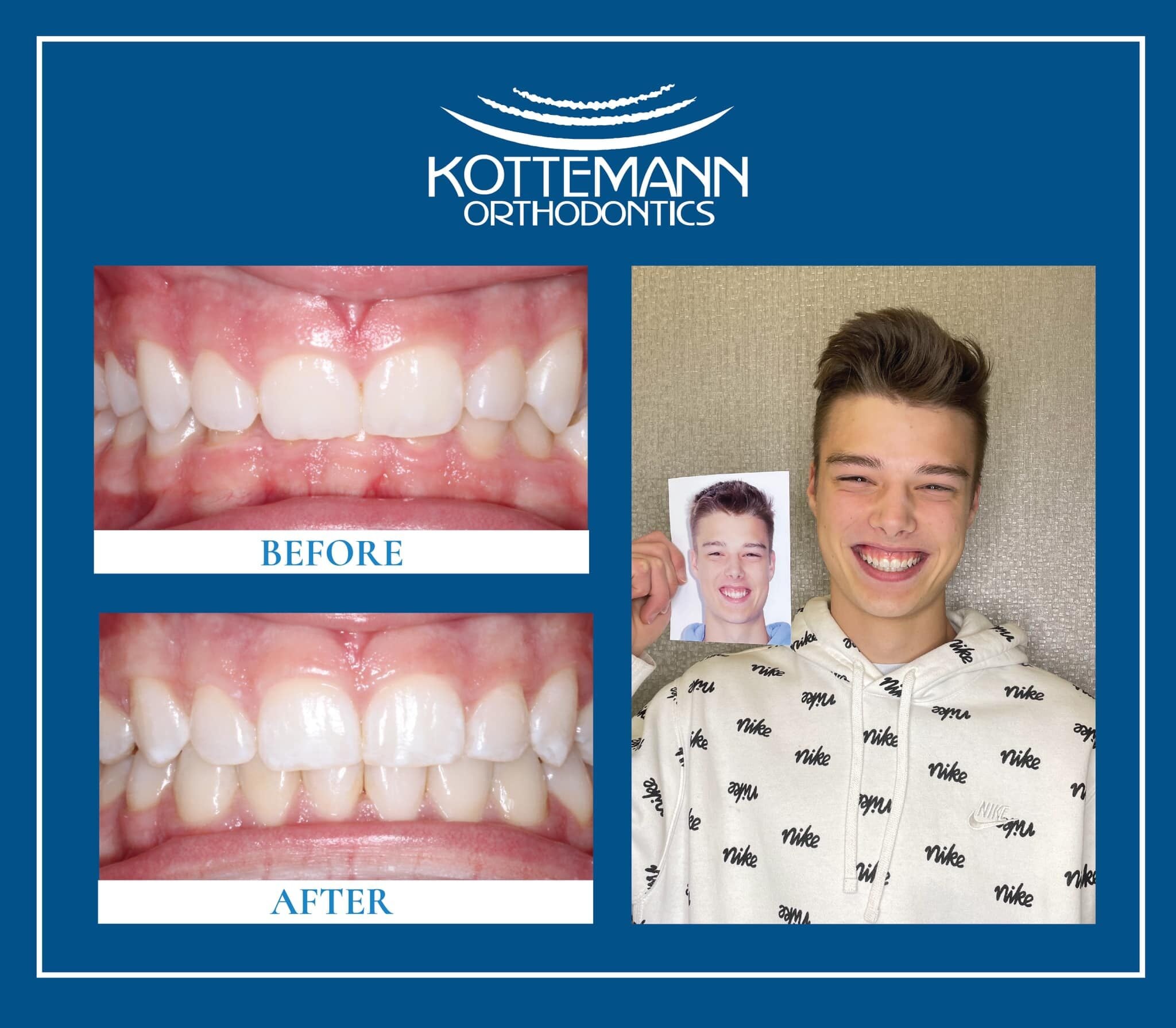 A person smiling, holding a photo of themselves. Two images show teeth "before" and "after" orthodontic treatment, with Kottemann Orthodontics branding.