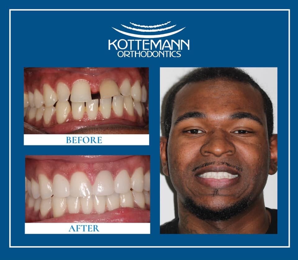 "user": A person smiling, showcasing before-and-after orthodontic results. Top: spaced teeth. Bottom: corrected alignment. "KOTTMANN ORTHODONTICS" brand logo and text.